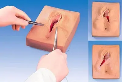 Tiểu phẫu cắt môi bé vùng kín: Cho "cô bé" trẻ trung như tuổi đôi mươi
