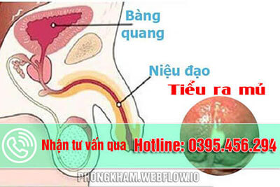 Tiểu ra mủ nguyên nhân cách điều trị tốt nhất tại nhà 2025