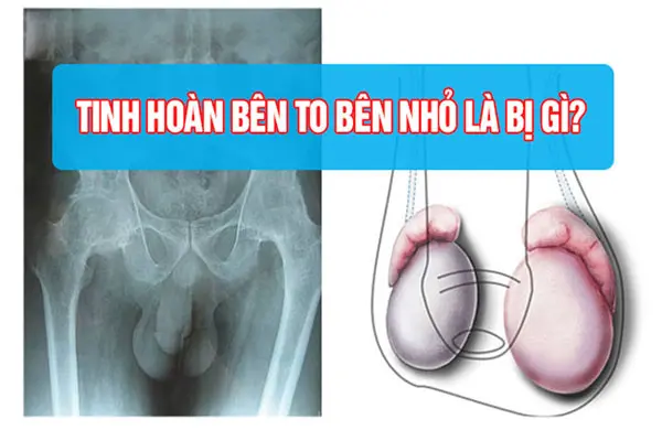Tinh hoàn bên to bên nhỏ có sao không, có con được không?