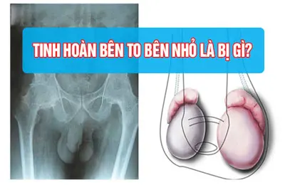 Tinh hoàn bên to bên nhỏ có sao không, có con được không?