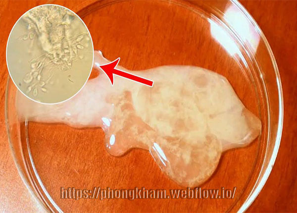 Tinh trùng có màu vàng do yếu tố bệnh lý