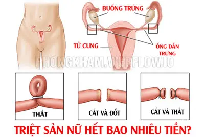 Triệt sản nữ hết bao nhiêu tiền BS Trần Thị Thành giải đáp
