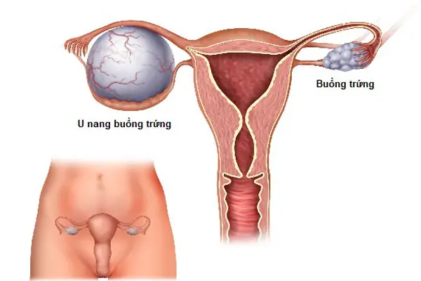 Tìm hiểu u nang buồng trứng là gì?