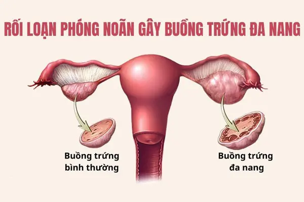 Triệu chứng, dấu hiệu u nang buồng trứng thường gặp