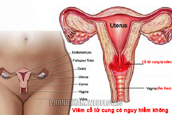 Viêm cổ tử cung có nguy hiểm không?