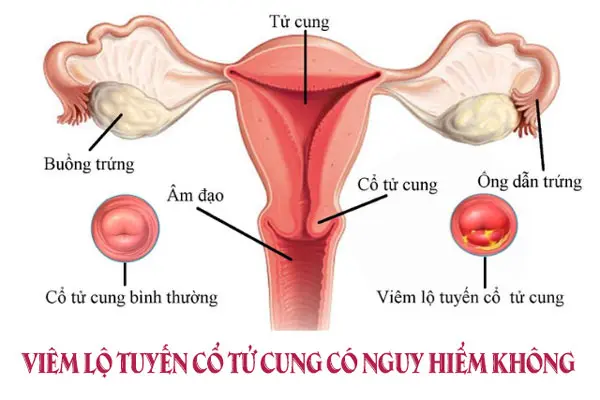 Thông tin về bệnh viêm lộ tuyến cổ tử cung là gì