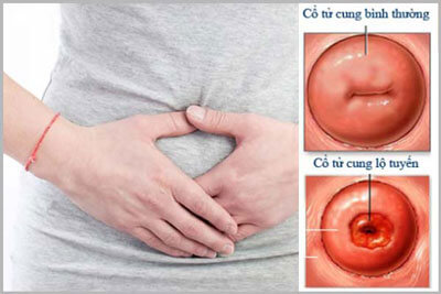 Viêm lộ tuyến cổ tử cung có thai được không [BS Trần Thị Thành Tư vấn]