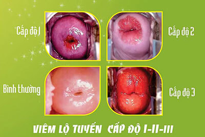 Viêm lộ tuyến cổ tử cung độ 3, độ 1, 2 phân biệt