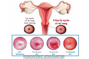Viêm lộ tuyến cổ tử cung: Nguyên nhân, triệu chứng, 4 cách trị hiệu quả nhất