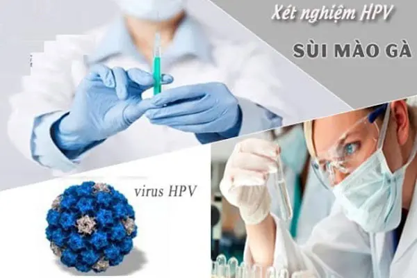 Những phương pháp xét nghiệm chẩn đoán bệnh sùi mào gà