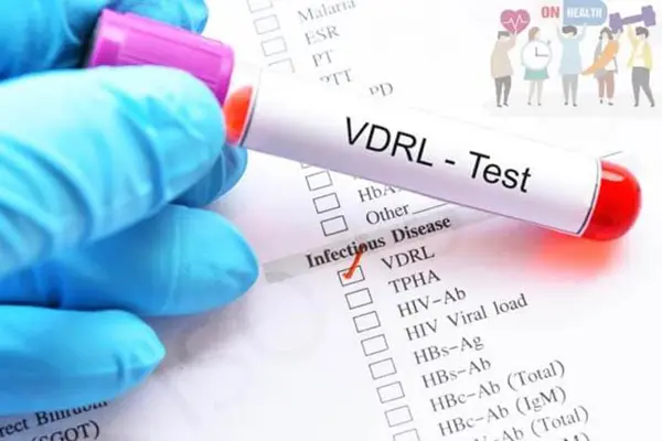Tìm hiểu xét nghiệm VDRL là gì?