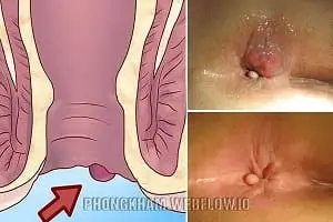 23 Địa chỉ phòng khám chữa bệnh trĩ ở đâu tốt nhất Hà Nội 2025