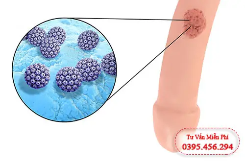 Bị đau tức, buốt dương do ung thư dương vật