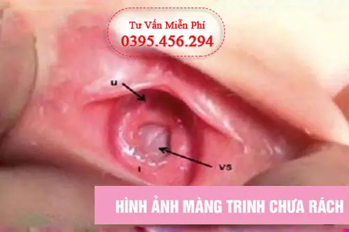 Hình ảnh màng trinh bị rách không phải do quan hệ tình dục