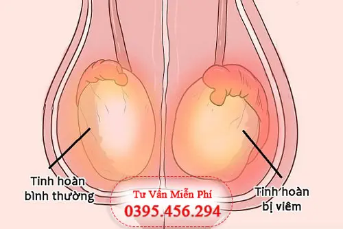 Phác đồ điều trị viêm tinh hoàn