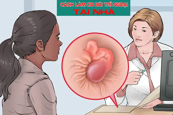 Cách làm co búi trĩ ngoại tại nhà giúp teo trĩ nhanh nhất