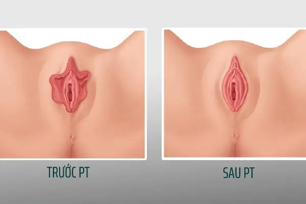 Quy trình thực hiện thu nhỏ môi bé vùng kín