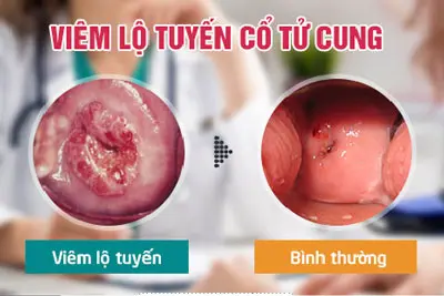 Viêm lộ tuyến cổ tử cung có nguy hiểm không? BS Giải Đáp