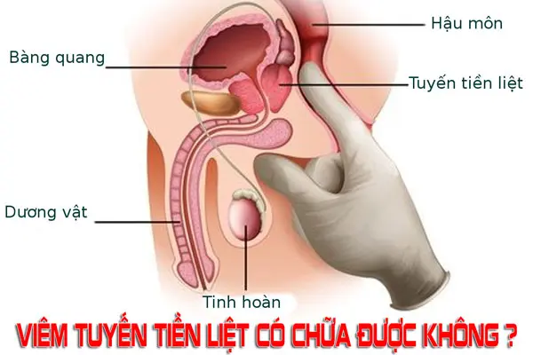 Bệnh viêm tuyến tiền liệt có chữa được không - phương pháp điều trị