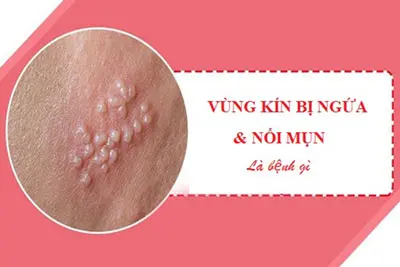 Vùng kín bị ngứa và nổi hạt, mụn trắng đỏ ở nam, nữ nguyên nhân cách chữa