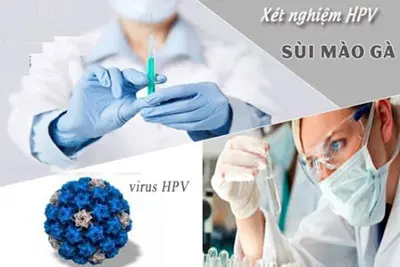 Xét nghiệm sùi mào gà như thế nào, ở đâu tốt?