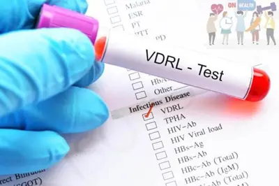 VDRL là xét nghiệm gì? Xét nghiệm VDRL giang mai âm tính là như thế nào?