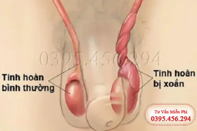Xoắn tinh hoàn nguyên nhân và cách chữa trị hiệu quả nhất
