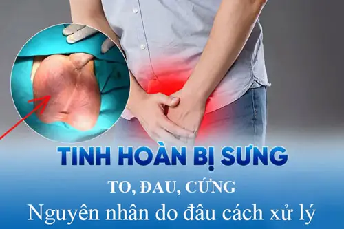 Tinh hoàn sưng to, đau, cứng là bệnh gì?