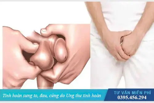 Tinh hoàn sưng to, đau do ung thư tinh hoàn