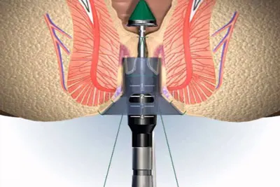 Review cắt trĩ có đau không, bao lâu thì lành? Kinh nghiệm thực tế