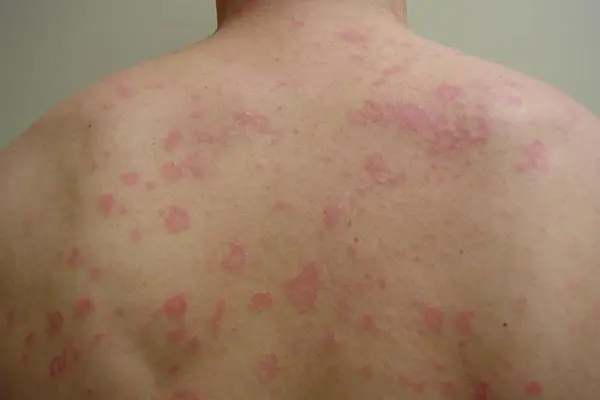 Săng giang mai là gì?