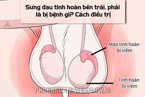 Sưng đau tinh hoàn bên trái, phải là bị bệnh gì? 7 Cách điều trị hiệu quả