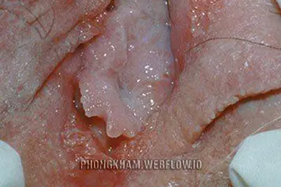 Sùi mào gà cổ tử cung hình ảnh cách điều trị hiệu quả