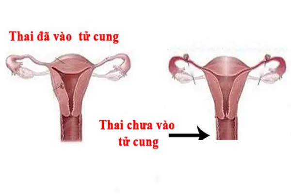 Thai chưa vào tử cung nên kiêng gì?