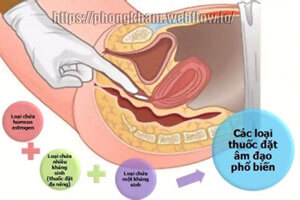 TOP 6 Thuốc đặt chữa viêm âm đạo hiệu quả nhất 2026