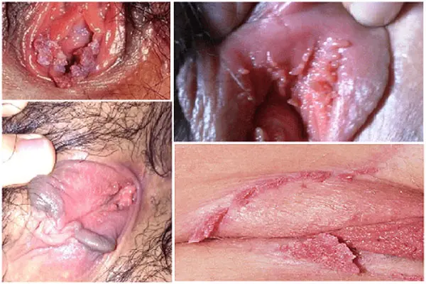 Hình ảnh nổi mụn ở môi bé vùng kín do sùi mào gà