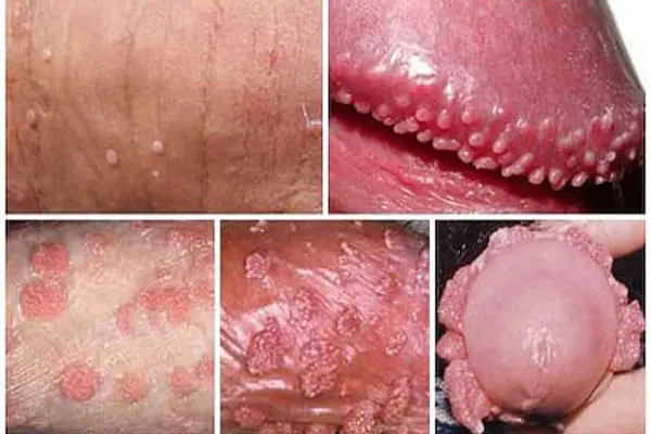 Hình ảnh nổi mụn ở vùng kín nam giới do sùi mào gà