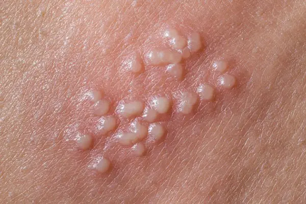 Hình ảnh nổi mụn ở vùng kín nam giới do viêm bao quy đầu