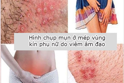 99+ Hình ảnh nổi mụn ở vùng kín nữ ở mép âm đạo, nam giới dương vật