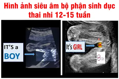 Hình ảnh siêu âm bộ phận sinh dục của thai nhi 12-15 tuần