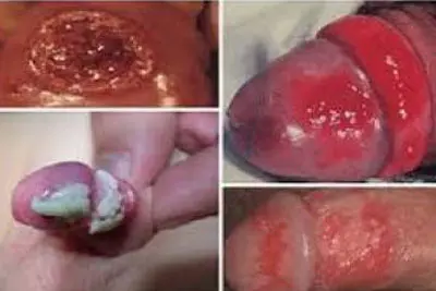 Hình ảnh viêm bao quy đầu ở nam giới chi tiết thật