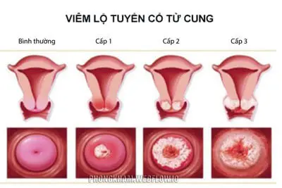 Hình ảnh viêm lộ tuyến cổ tử cung độ 1 2 3 qua từng giai đoạn