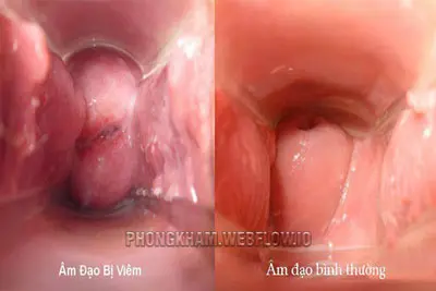 100+ Hình ảnh bị nấm vùng kín viêm âm đạo viêm phụ khoa ở nữ giới thực tế