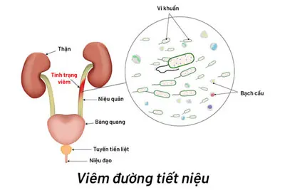 Khám viêm đường tiết niệu như thế nào? BS Trần thị Thành giải đáp