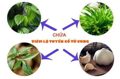 Mẹo chữa viêm lộ tuyến cổ tử cung tại nhà hiệu quả nhất 2025