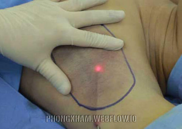 Trị hôi nách vĩnh viễn an toàn bằng cách can thiệp ngoại khoa