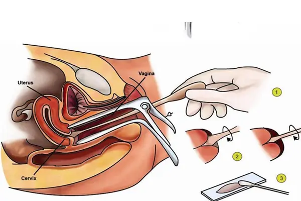Quy trình sử dụng mỏ vịt khám phụ khoa nữ