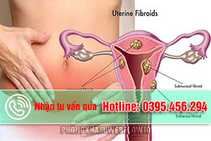 Bệnh u xơ cổ tử cung Nguyên nhân triệu chứng thường gặp nhất