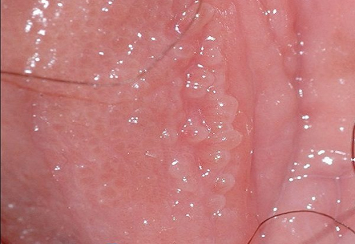 Nổi mụn vùng kín do gai sinh dục