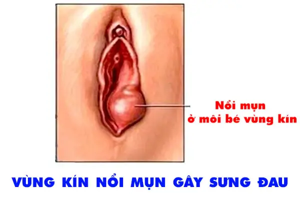 Nguyên nhân và hình ảnh nổi mụn ở môi bé vùng kín